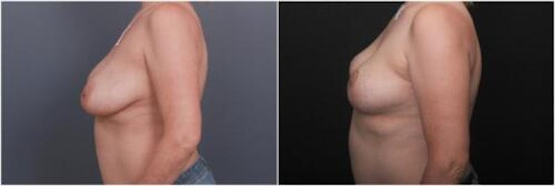 Breast Reduction Before & After Gallery - Patient 898861 - Image 4