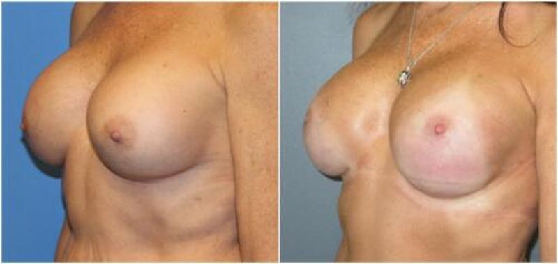Breast Reconstruction Before & After Gallery - Patient 150089 - Image 3