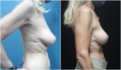 Breast Reduction Before & After Gallery - Patient 342693 - Image 1