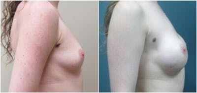 Breast Reconstruction Before & After Gallery - Patient 114714 - Image 1