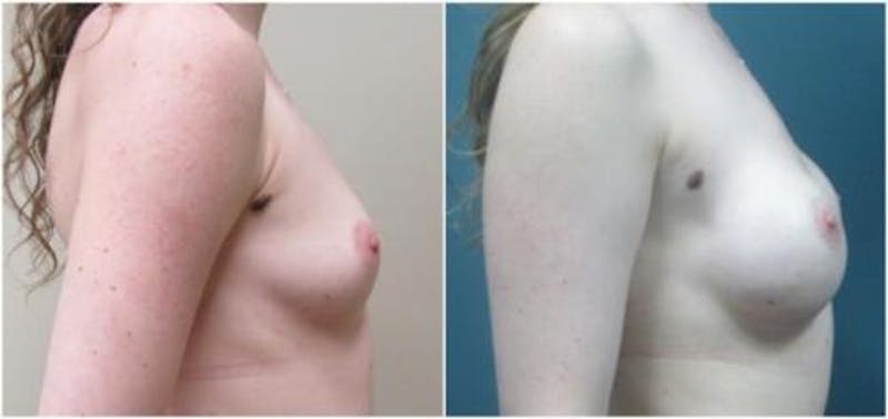 Breast Reconstruction Before & After Gallery - Patient 114714 - Image 1