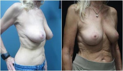 Breast Reduction Before & After Gallery - Patient 342693 - Image 2