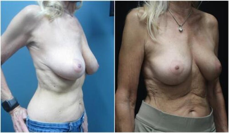 Breast Reduction Before & After Gallery - Patient 342693 - Image 2
