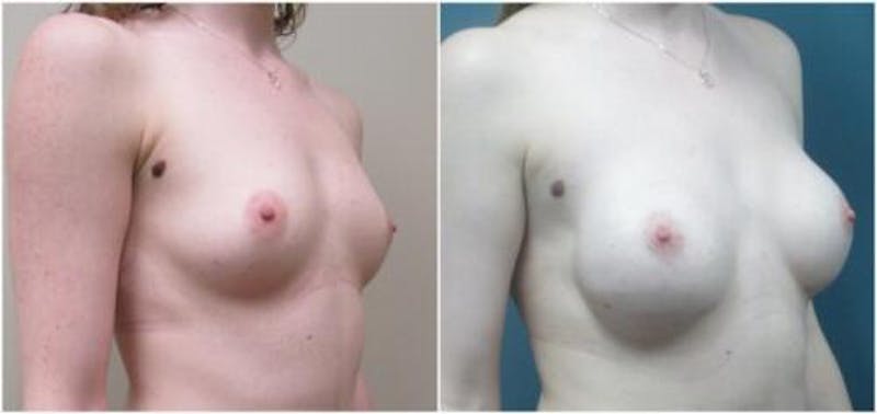 Breast Reconstruction Before & After Gallery - Patient 114714 - Image 2