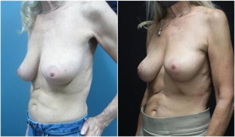 Breast Reduction Before & After Gallery - Patient 342693 - Image 3