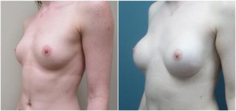 Breast Reconstruction Before & After Gallery - Patient 114714 - Image 3
