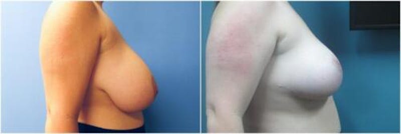 Breast Reduction Before & After Gallery - Patient 874111 - Image 1