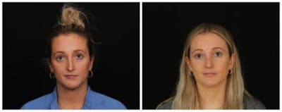 Rhinoplasty Before & After Gallery - Patient 172498 - Image 1