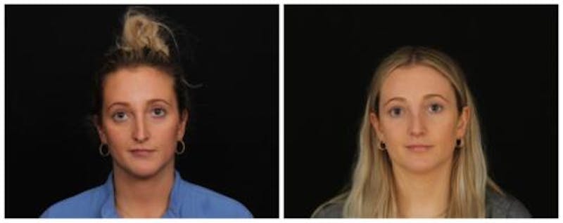 Rhinoplasty Before & After Gallery - Patient 172498 - Image 1