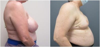 Breast Reconstruction Before & After Gallery - Patient 148546 - Image 1
