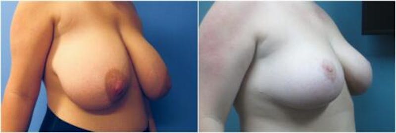 Breast Reduction Before & After Gallery - Patient 874111 - Image 2