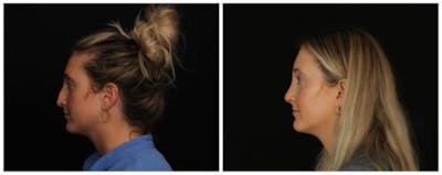 Rhinoplasty Before & After Gallery - Patient 172498 - Image 2