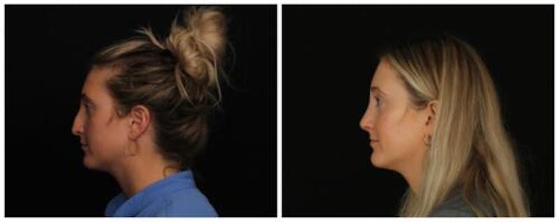 Rhinoplasty Before & After Gallery - Patient 172498 - Image 2