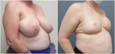 Breast Reconstruction Before & After Gallery - Patient 148546 - Image 2