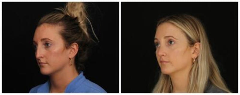 Rhinoplasty Before & After Gallery - Patient 172498 - Image 3
