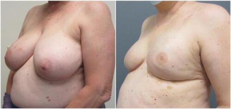 Breast Reconstruction Before & After Gallery - Patient 148546 - Image 3