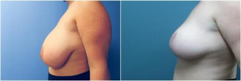 Breast Reduction Before & After Gallery - Patient 874111 - Image 4