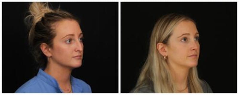 Rhinoplasty Before & After Gallery - Patient 172498 - Image 4