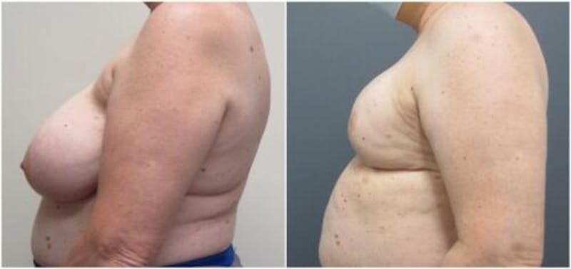 Breast Reconstruction Before & After Gallery - Patient 148546 - Image 4
