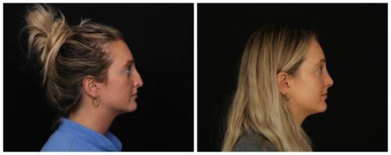 Rhinoplasty Before & After Gallery - Patient 172498 - Image 5