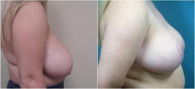 Breast Reduction Before & After Gallery - Patient 281109 - Image 1
