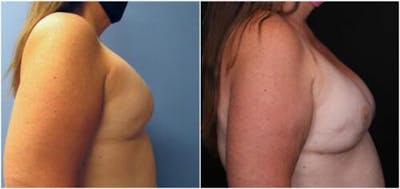 Breast Reconstruction Before & After Gallery - Patient 184646 - Image 1