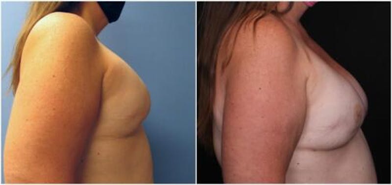 Breast Reconstruction Before & After Gallery - Patient 184646 - Image 1