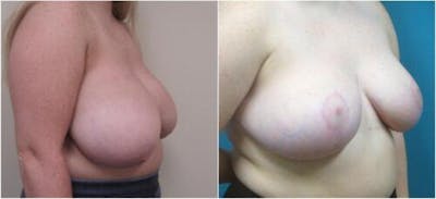 Breast Reduction Before & After Gallery - Patient 281109 - Image 2