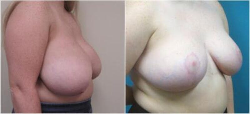 Breast Reduction Before & After Gallery - Patient 281109 - Image 2