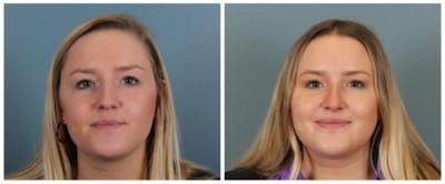 Rhinoplasty Before & After Gallery - Patient 938973 - Image 1