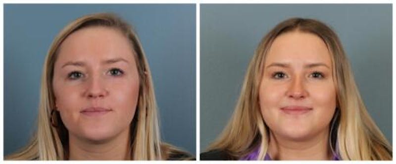 Rhinoplasty Before & After Gallery - Patient 938973 - Image 1