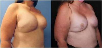 Breast Reconstruction Before & After Gallery - Patient 184646 - Image 2
