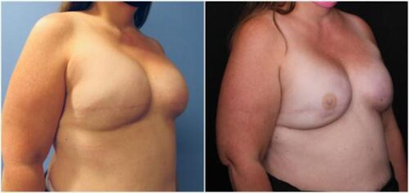Breast Reconstruction Before & After Gallery - Patient 184646 - Image 2
