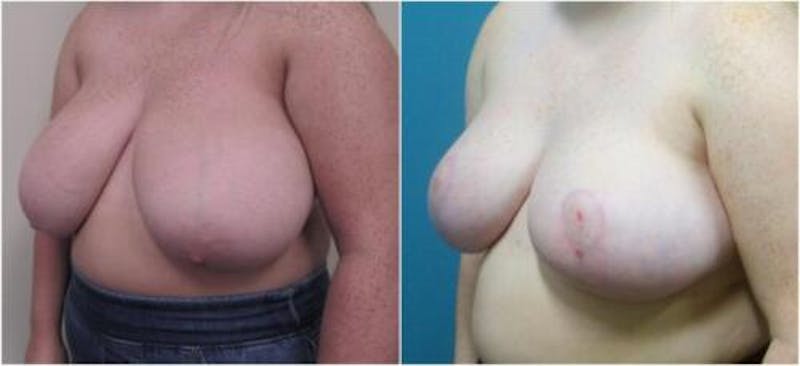 Breast Reduction Before & After Gallery - Patient 281109 - Image 3