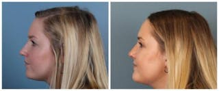 Rhinoplasty Before & After Gallery - Patient 938973 - Image 2