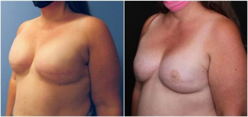 Breast Reconstruction Before & After Gallery - Patient 184646 - Image 3
