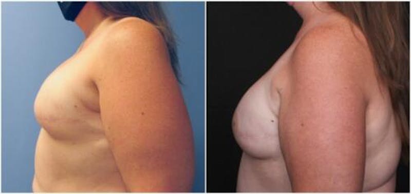 Breast Reconstruction Before & After Gallery - Patient 184646 - Image 4