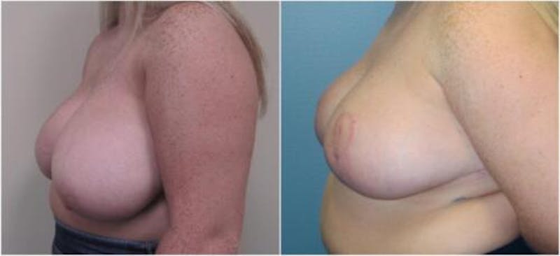 Breast Reduction Before & After Gallery - Patient 281109 - Image 4