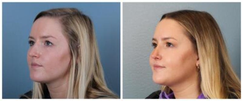 Rhinoplasty Before & After Gallery - Patient 938973 - Image 3