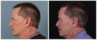 Otoplasty Before & After Gallery - Patient 840455 - Image 1