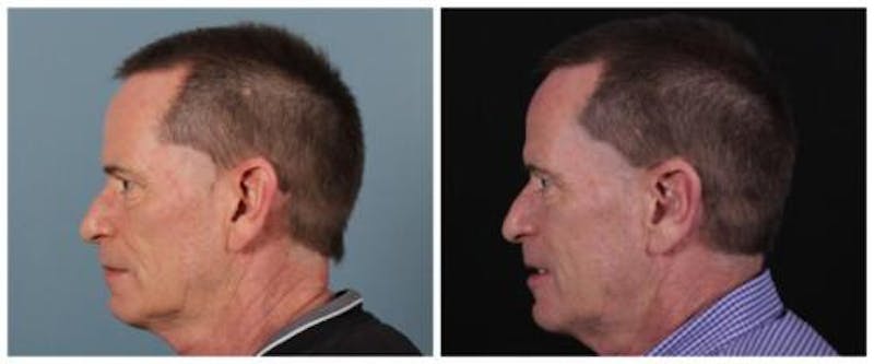 Otoplasty Before & After Gallery - Patient 840455 - Image 1