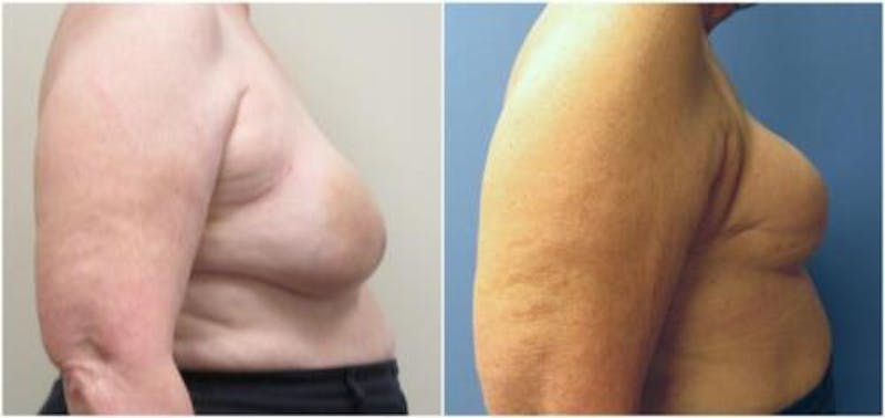 Breast Reconstruction Before & After Gallery - Patient 394190 - Image 1