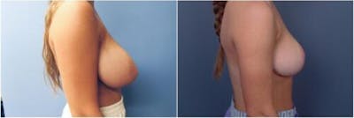 Breast Reduction Before & After Gallery - Patient 393378 - Image 1