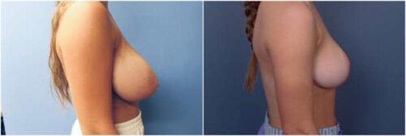 Breast Reduction Before & After Gallery - Patient 393378 - Image 1