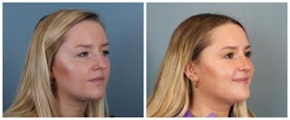 Rhinoplasty Before & After Gallery - Patient 938973 - Image 4