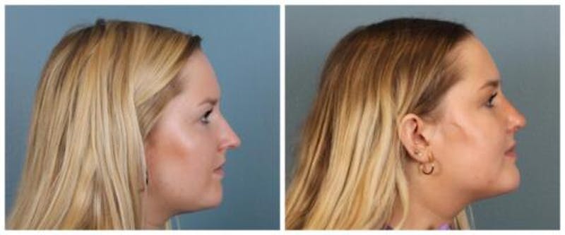 Rhinoplasty Before & After Gallery - Patient 938973 - Image 5