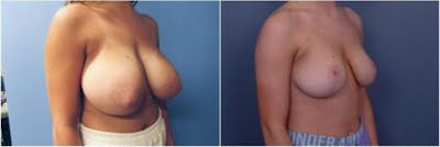 Breast Reduction Before & After Gallery - Patient 393378 - Image 2