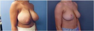 Breast Reduction Before & After Gallery - Patient 393378 - Image 2