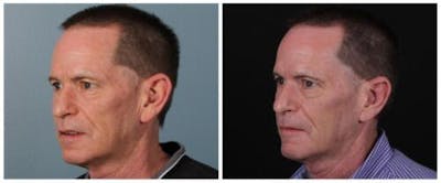 Otoplasty Before & After Gallery - Patient 840455 - Image 2