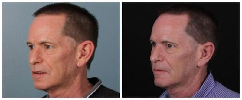 Otoplasty Before & After Gallery - Patient 840455 - Image 2